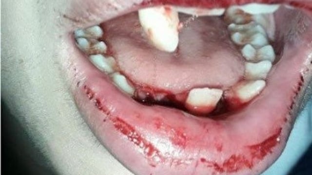 El joven golpeado perdiu00f3 cinco dientes y le quebraron el maxilar inferior.