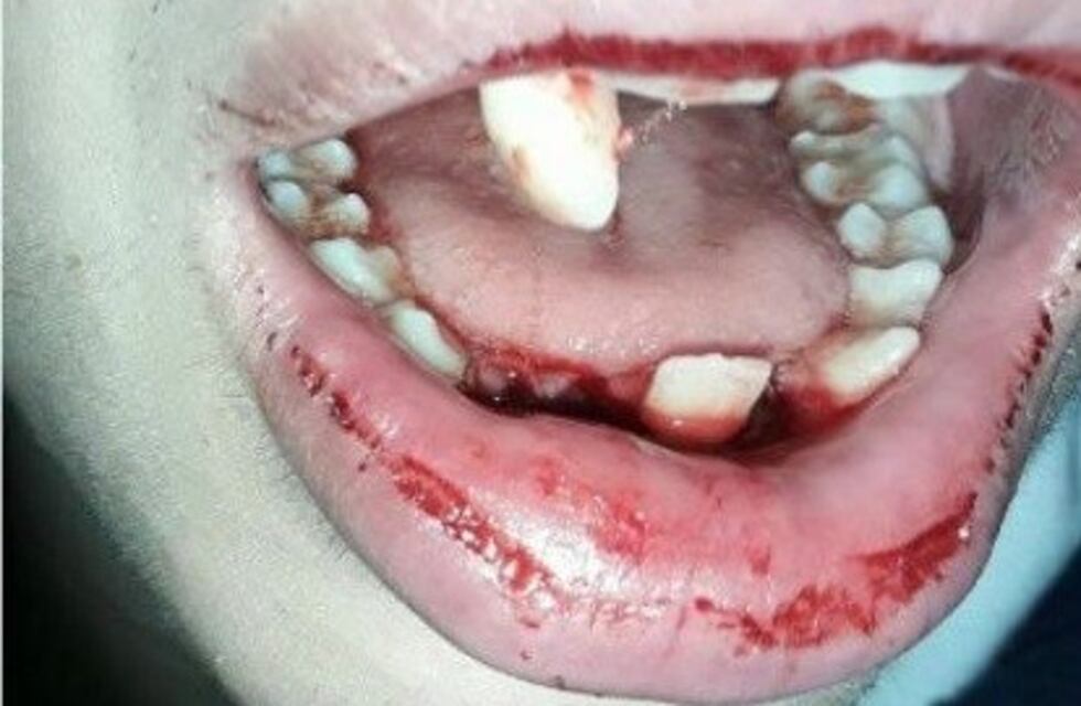 Desde el Ministerio de Educación confirmaron que no van a expulsar al chico que le quebró el maxilar a un compañero