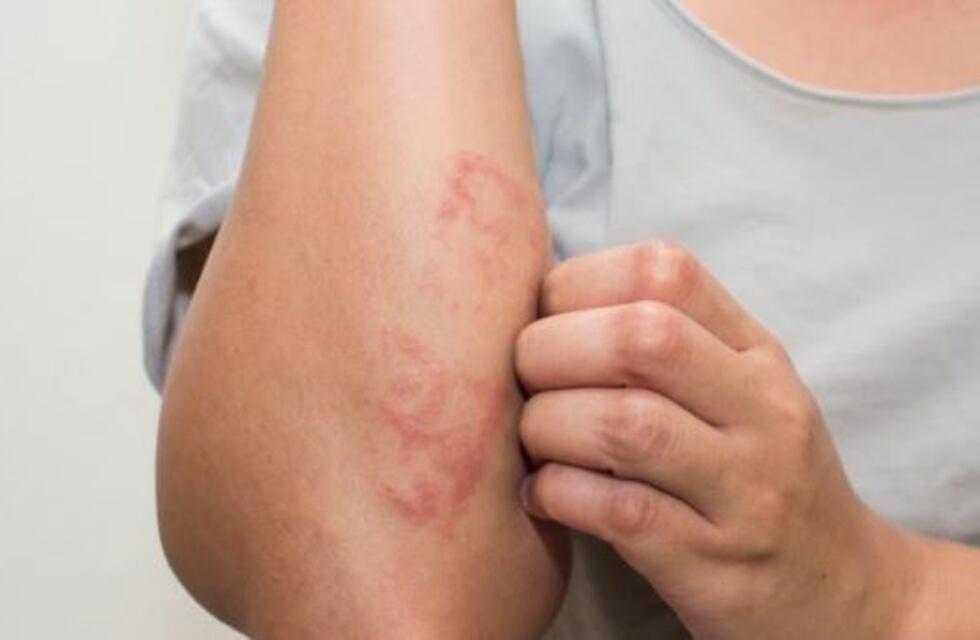 Sierras Chicas: arranca la campaña de detección y control de psoriasis