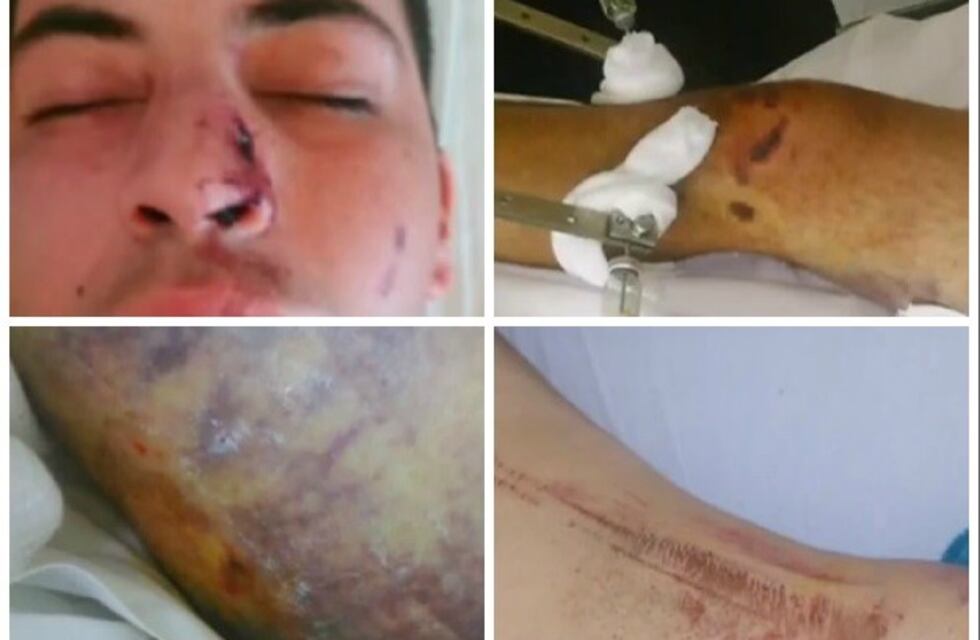 Un joven está internado con múltiples fracturas y denuncian que la policía lo chocó