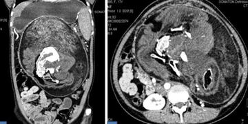 17 años con un feto en su cuerpo