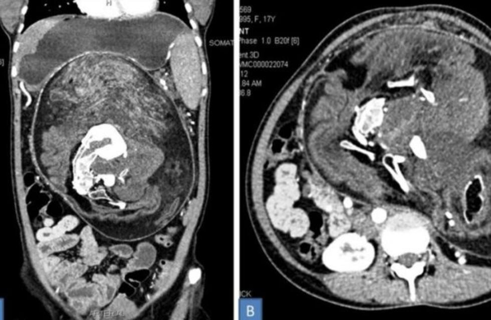 Sin saberlo, vivió 17 años con un feto en su cuerpo