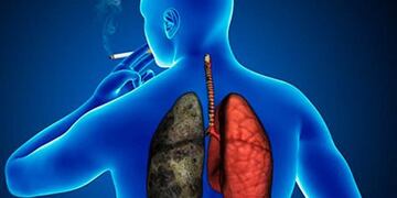 Afectación de los pulmones por la EPOC\u002E