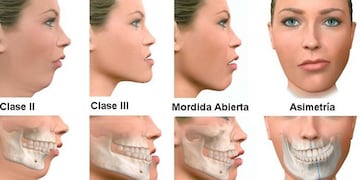 cirugía maxilofacial ortognática