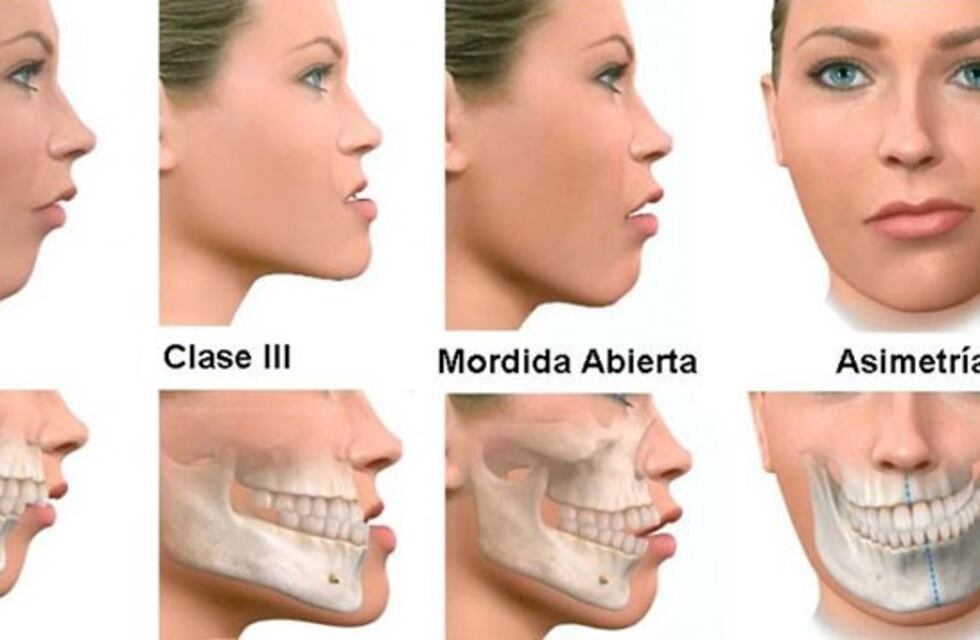 Realizaron una cirugía maxilofacial tipo "ortognática" por primera vez en San Luis