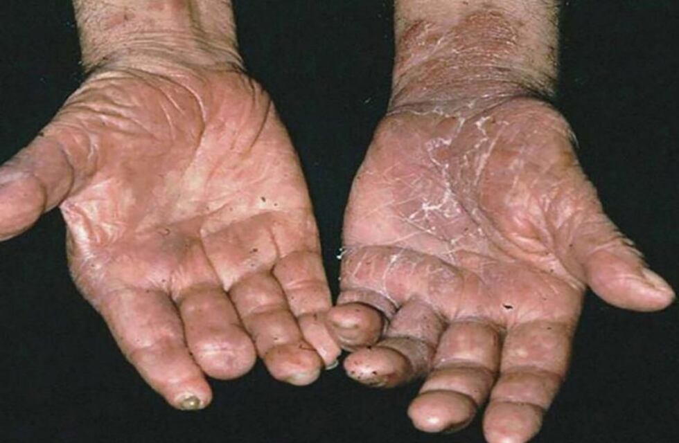 Chaco se suma a la Campaña Nacional de Prevención de la Lepra