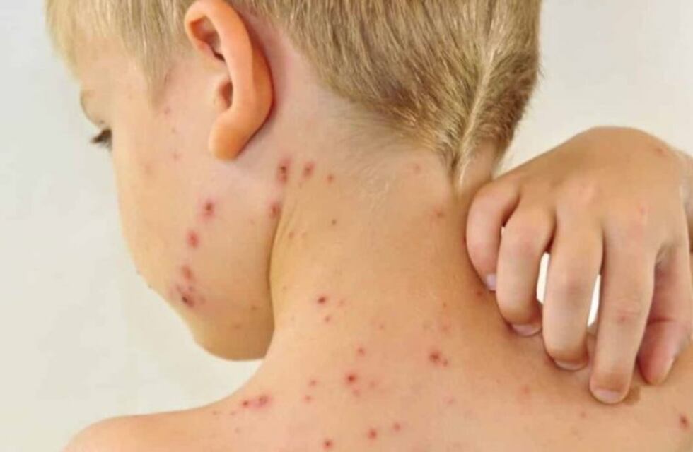 Confirmaron cuatro casos de sarna en colegios de Paraná