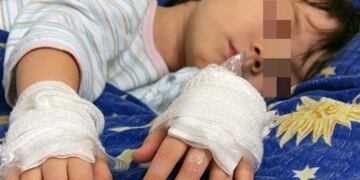 Menor quemado por su madre\u002E