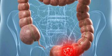 Prevención y diagnóstico precoz, las claves para combatir el cáncer de colon