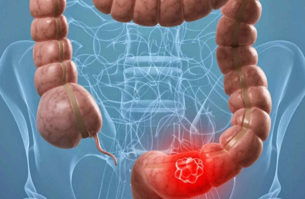 Prevención y diagnóstico precoz, las claves para combatir el cáncer de colon