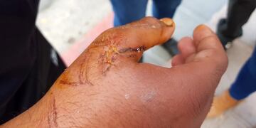 El vecino fue gravemente herido por un pitbull que ya lo había atacado varias veces.