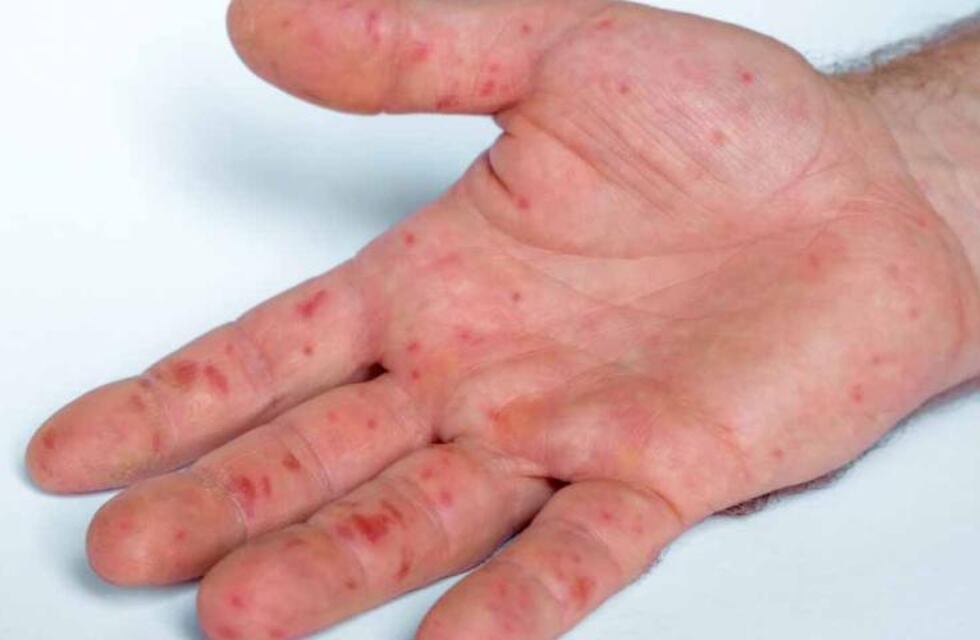 Viruela del mono: Rosario confirmó el segundo caso tras un viaje a España