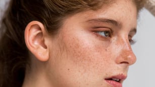 Manchas en la piel: qué tipos existen, a qué edad aparecen y cómo prevenirlas