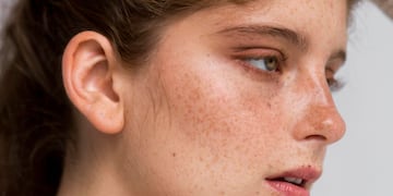 Manchas en la piel: qué tipos existen, a qué edad aparecen y cómo prevenirlas