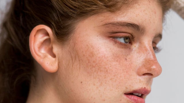 Manchas en la piel: qué tipos existen, a qué edad aparecen y cómo prevenirlas