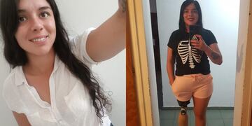 Estefanía González, deportista que necesita cambiar su pierna ortopédica.