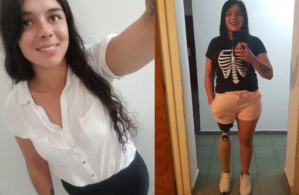 Una joven deportista sanluiseña espera una pierna ortopédica desde hace dos años