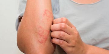 Campaña gratuita de detección de psorisis en San Rafael. (Foto/La Voz).