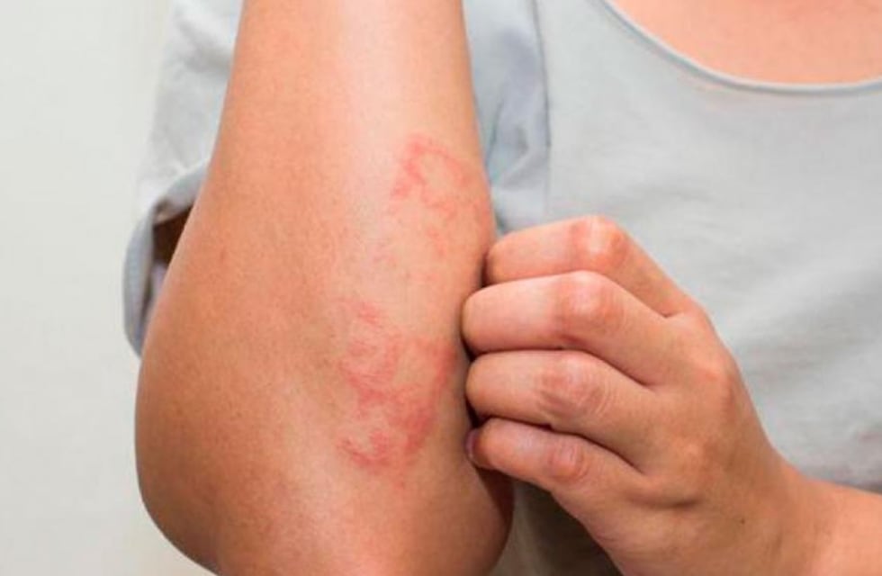 Lanzaron una campaña para detectar a personas que padecen psoriasis y tratarlos de manera temprana