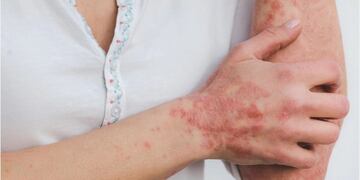 Todos los 29 de octubre se celebra el Día Mundial de la Psoriasis con la intención de informar y concientizar a la población sobre la enfermedad que afecta a personas de todas las edades.