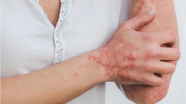 Todos los 29 de octubre se celebra el Día Mundial de la Psoriasis con la intención de informar y concientizar a la población sobre la enfermedad que afecta a personas de todas las edades.