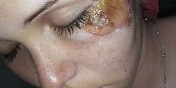 Milagros Padin publicó imágenes con sus lesiones en las redes sociales.