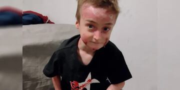 El niño de 8 años que tiene "piel de cristal".