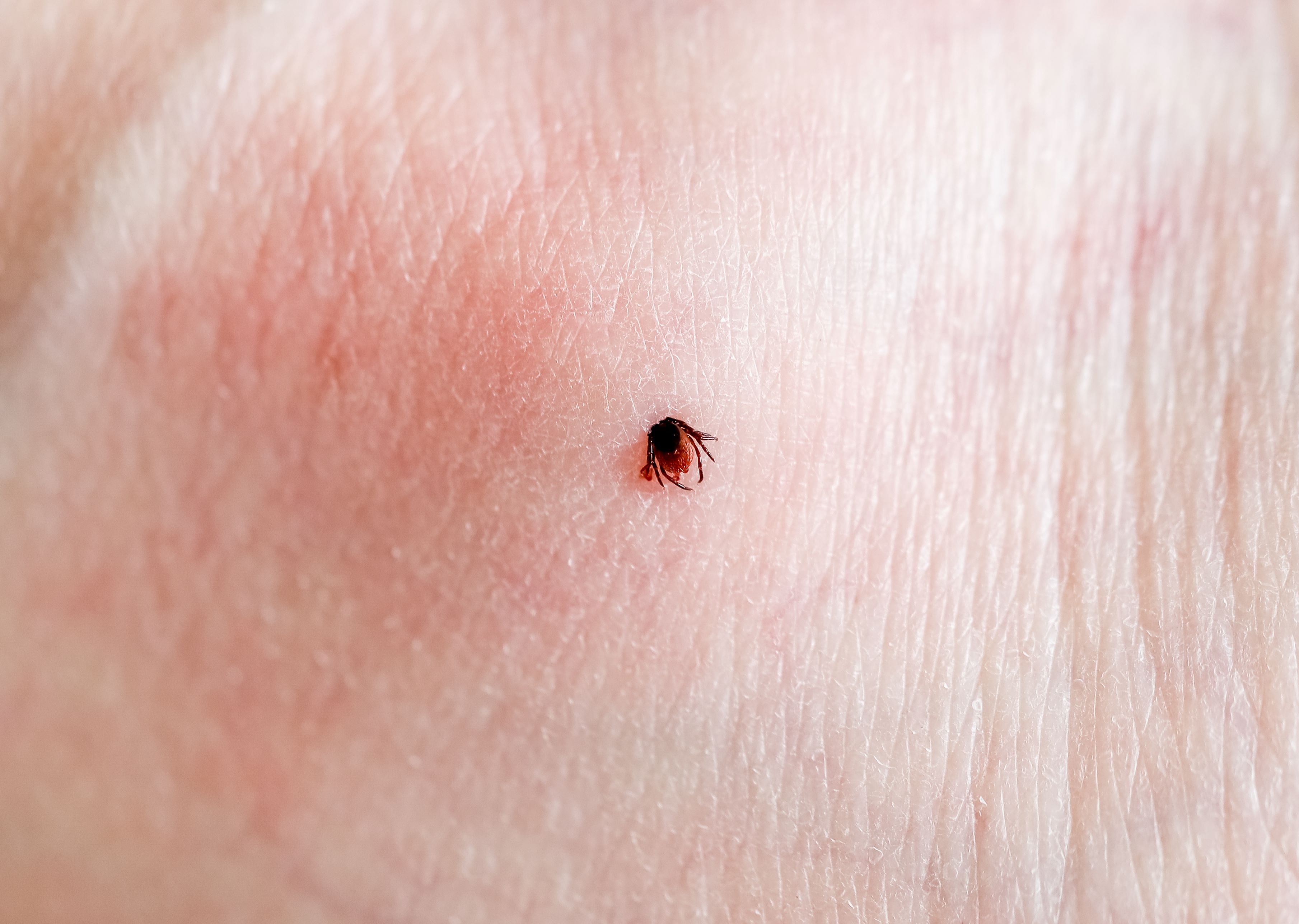 Esta enfermedad es transmitida principalmente por la picadura de una garrapata infectada.