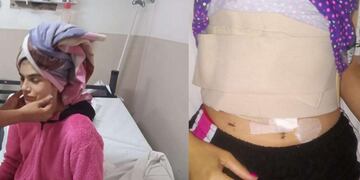 Tras ser apuñalada por su pareja, se recuperó rápidamente.