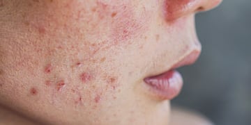 Este es el mejor método natural para eliminar el acné.