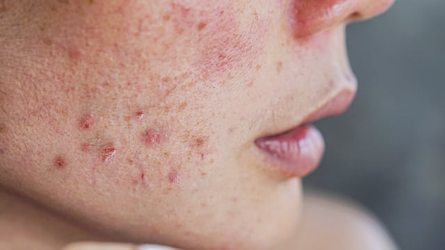Este es el mejor método natural para eliminar el acné.