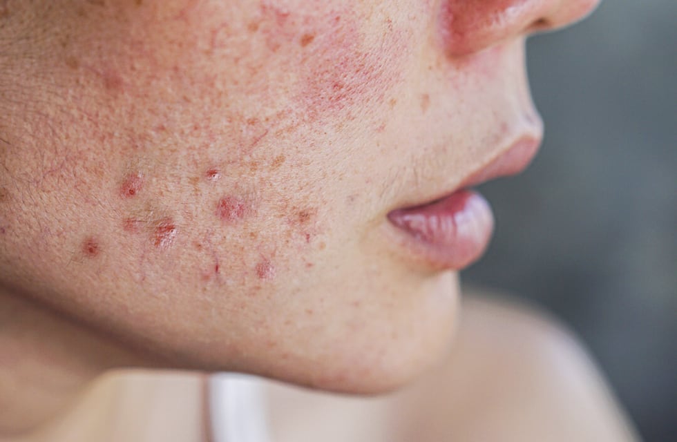 Chau granos: el método ideal para quitarlos de tu piel y olvidarte del acné