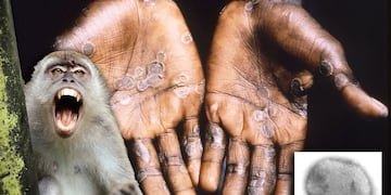 Se reportó en la Ciudad de Buenos Aires un caso sospechoso de viruela del mono.