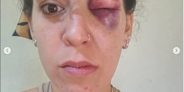 Romina Villacorta denunció ser salvajemente golpeada por su pareja en San Luis