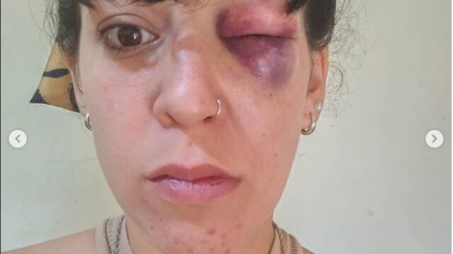Romina Villacorta denunció ser salvajemente golpeada por su pareja en San Luis