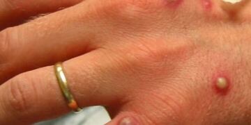 Investigan un caso sospechoso de viruela símica cerca de Misiones.