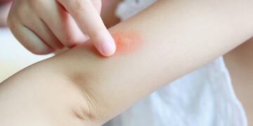 El dengue no se puede transmitir de persona a persona.