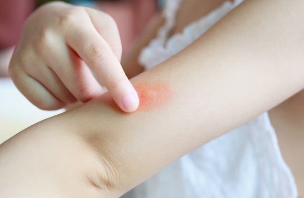 Arroyito: 6 de cada 10 consultas en la guardia y en consultorios del Hospital Carlos Rodríguez son por síntomas de dengue