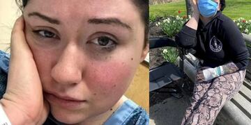 Lyndsi Johnson padece una rara enfermedad conocida como "alergia a la gravedad".