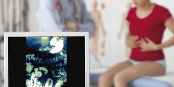 El cáncer de colon es el tumor más frecuente del aparato digestivo y ocupa el tercer lugar en ambos sexos. (Sanatorio Allende)