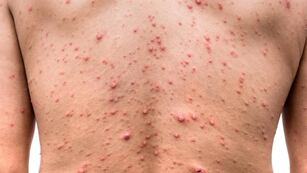 Cuáles son las vías de infección de la viruela del mono. El Gobierno de Córdoba compartió el plan de acción.