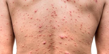 Cuáles son las vías de infección de la viruela del mono. El Gobierno de Córdoba compartió el plan de acción.