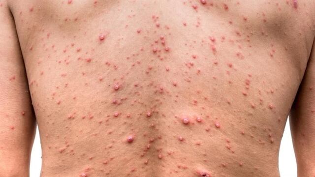 Cuáles son las vías de infección de la viruela del mono. El Gobierno de Córdoba compartió el plan de acción.