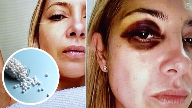 Así es el tratamiento con árnica que recibió Fabiola Yañez, recomendado por el médico de Alberto Fernández.