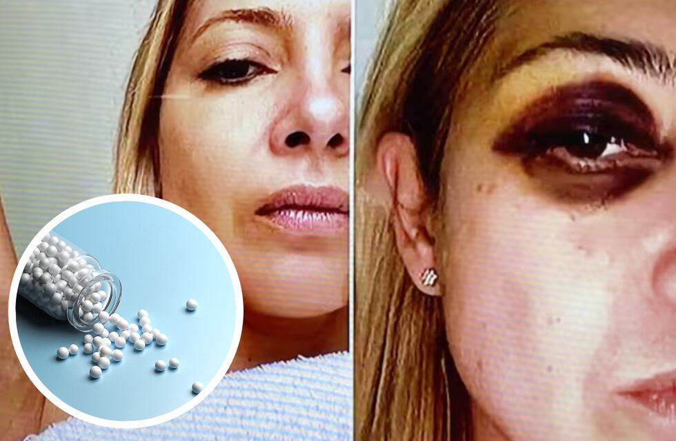 Así es el tratamiento con árnica que recibió Fabiola Yañez, recomendado por el médico de Alberto Fernández