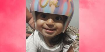 Oriana, la beba de San Luis que padece plagiocefalia, con su nuevo casco ortopédico.