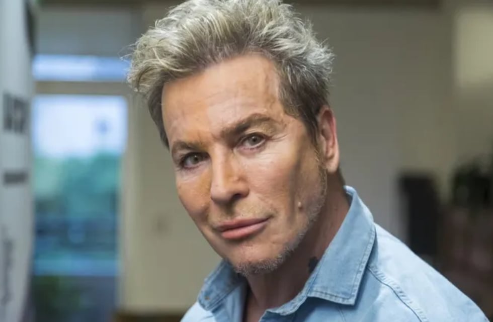 “200 quemaduras... “, el impactante antes y después de Güido Suller tras sus retoques estéticos