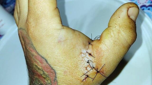 El profunde corte que recibió el tatuador por el ataque.