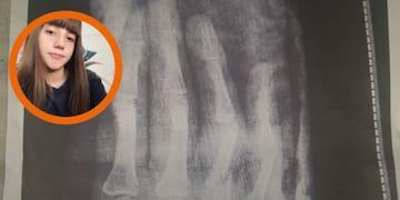 Puntaltense necesita con urgencia operarse de la mano y debe juntar más de 3 millones