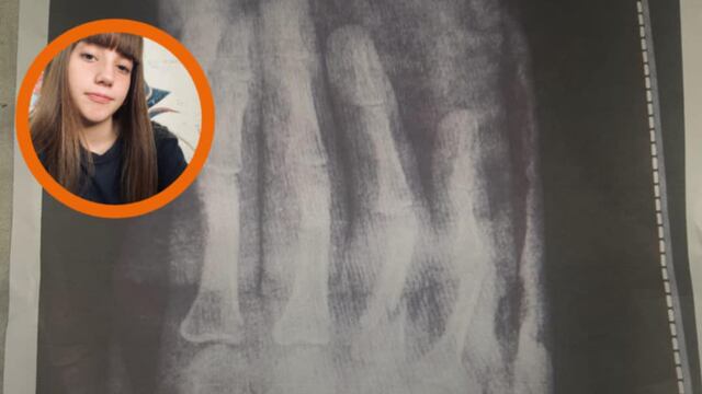 Puntaltense necesita con urgencia operarse de la mano y debe juntar más de 3 millones